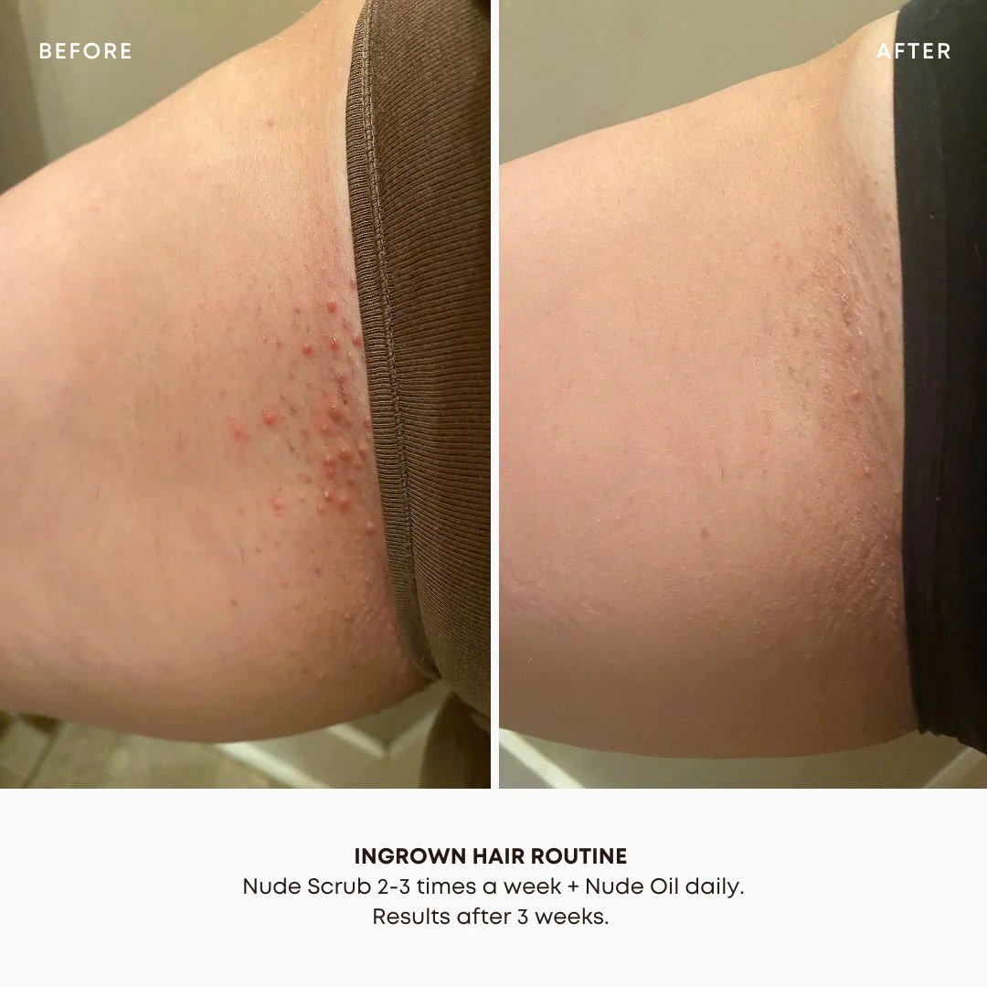 Nude Ingrown Hair Oil - Image 5