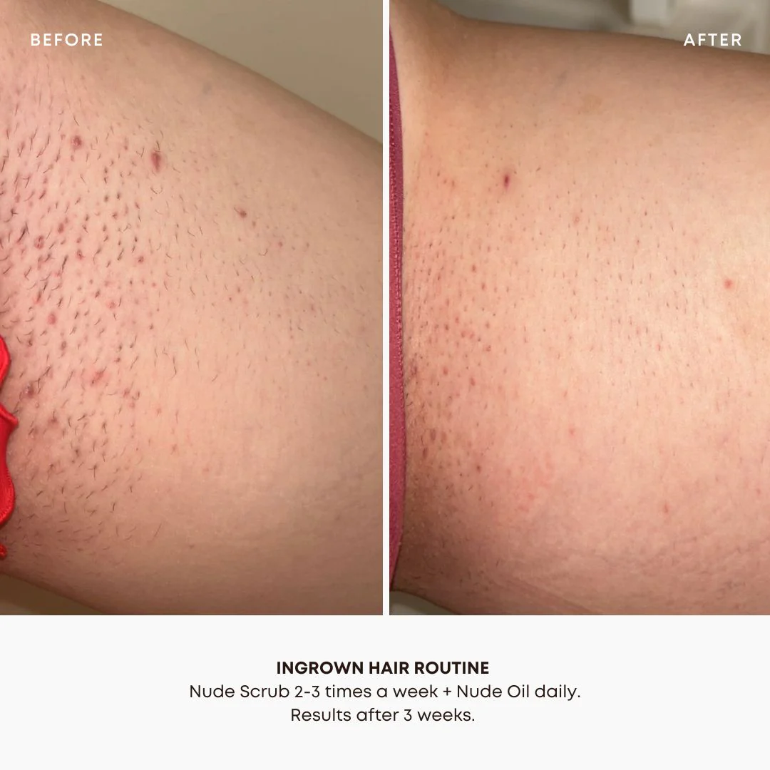 Nude Ingrown Hair 2 Step Routine - Image 6