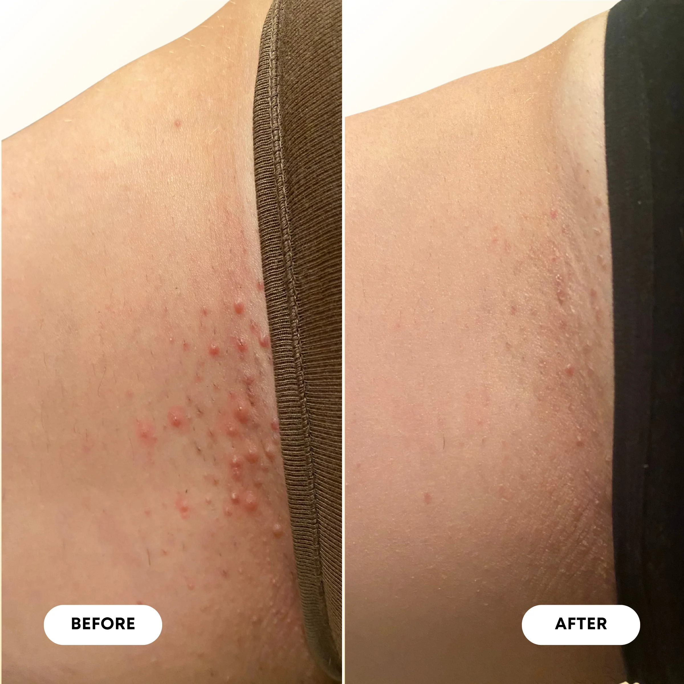 Vanilla Coconut Ingrown Hair Oil - Image 7